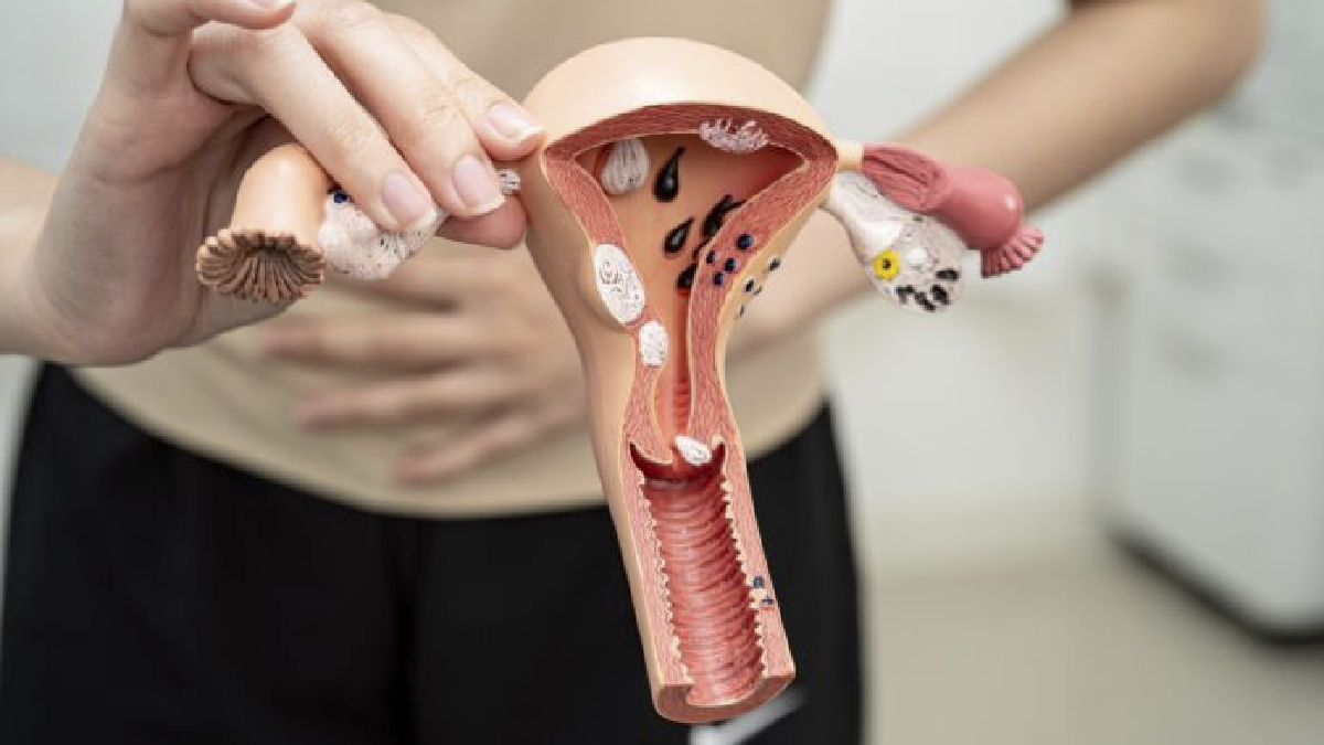 Cáncer de ovario: 7 de cada 10 casos se detectan tarde